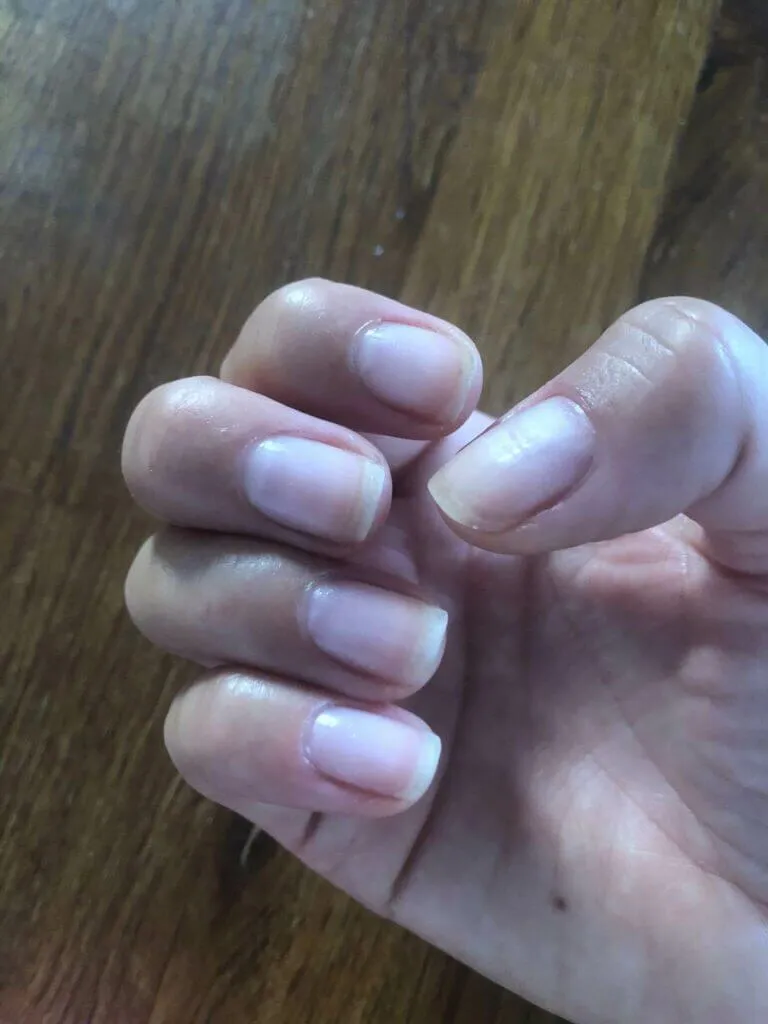 unghie dopo rimozione di maniko nails